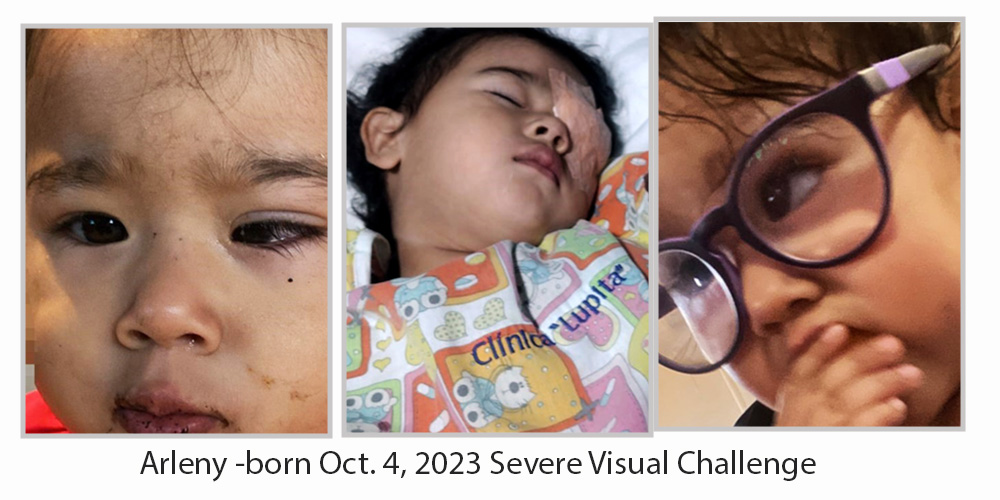 Arleny Eye challenge, recovery at hospital post surgery, Glasses